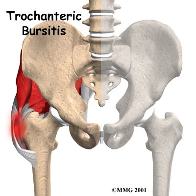 trochanteric bursitis