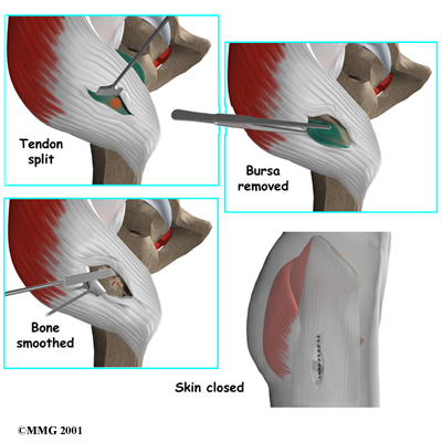 Physical Therapy in Northern Virginia for Trochanteric Bursitis of the Hip