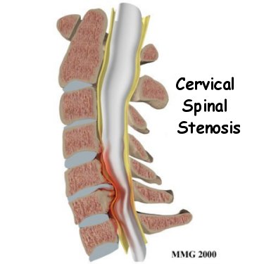 Spinal Stenosis - Biscup Spine