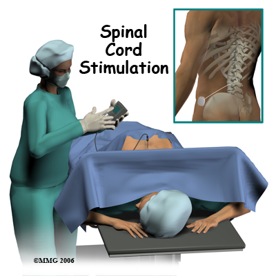 Spinal Cord Stimulation Washington, PA
